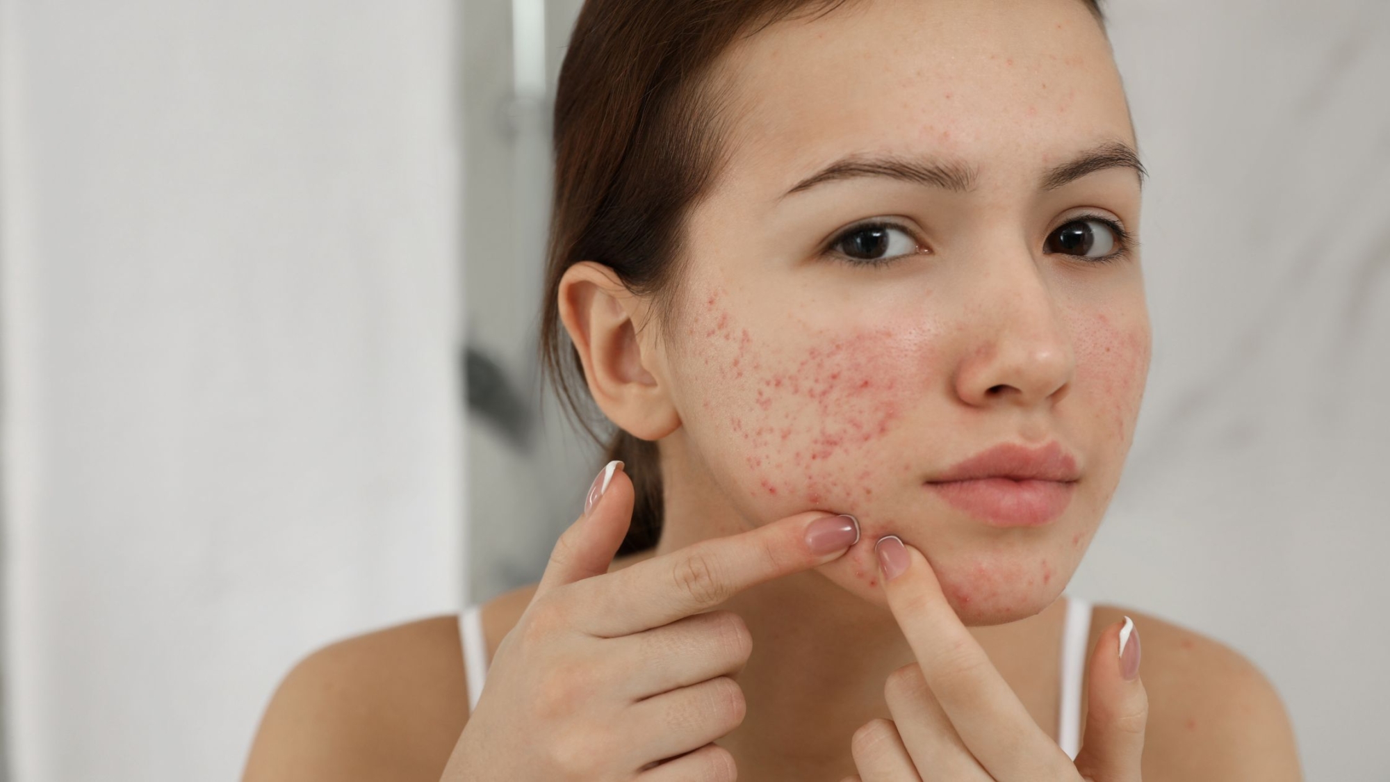 Acne-Treatment (1)