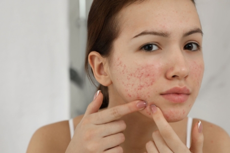 Acne-Treatment (1)