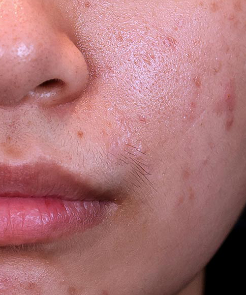 Mole-remove-after