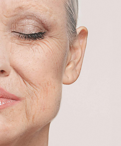 botox-before